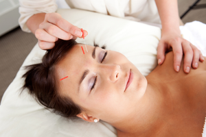 facial-acupuncture